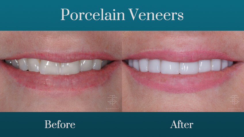before and after porcelain ven